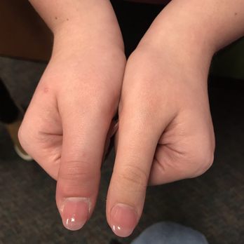 Signature Nails - Thumb on left infected - Nail Salons Near Me - Springfield, Missouri Signature Nails - Thumb on left infected - Nail Salons Near Me - Springfield, Missouri