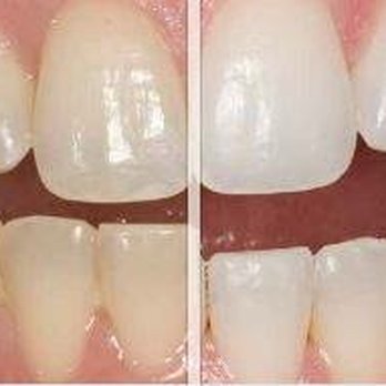 82nd Drive Dental - In-office Whitening - General Dentistry Near Me - Clackamas, Oregon 82nd Drive Dental - In-office Whitening - General Dentistry Near Me - Clackamas, Oregon