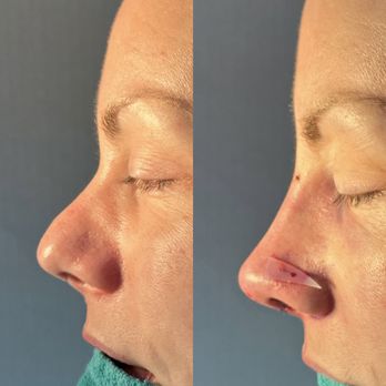 Eos Rejuvenation - On the table results - Cosmetic Surgeons Near Me - Beverly Hills, California Eos Rejuvenation - On the table results - Cosmetic Surgeons Near Me - Beverly Hills, California