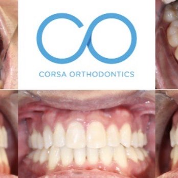 Corsa Orthodontics - After treatment - Orthodontists Near Me - San Jose, California