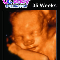 UC Baby - 3D Ultrasound