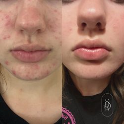 Sophia Hermida Aesthetics - Before and after