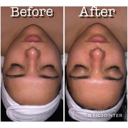 Spa721 - Before and after dermaplane
