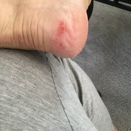 Bruises caused by excessive rubbing with brush. Bruises caused by excessive rubbing with brush.