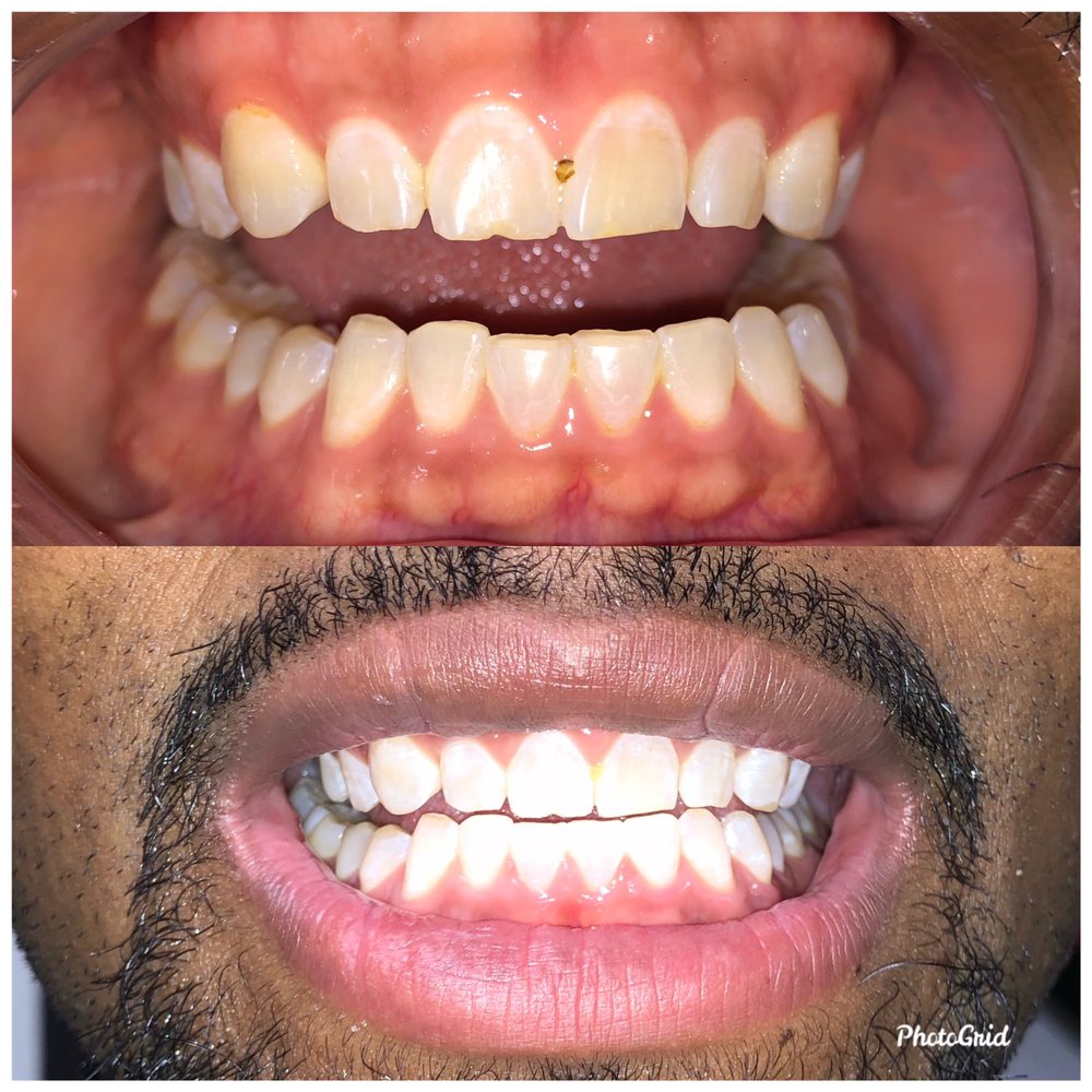 HQ TEETH WHITENING 12 Photos 1580 Stillwell Ave, The Bronx, New