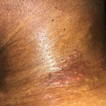 Silver Depot - This what their "REAL SILVER" chain did to my neck! - Jewelry Near Me - Palmdale, California