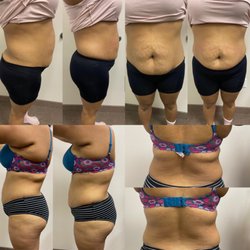 Body contouring