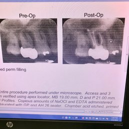 I think this is supposed to be "bad tooth/good tooth." I do like those pretty canal trails in the post pic... I think this is supposed to be "bad tooth/good tooth." I do like those pretty canal trails in the post pic...