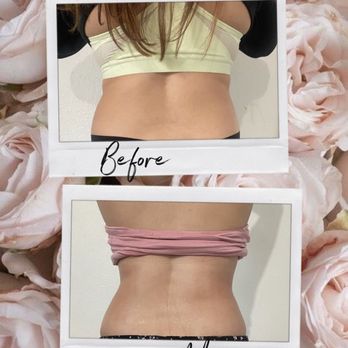 Body Visionss - Snatched! - Body Contouring Near Me Body Visionss - Snatched! - Body Contouring Near Me