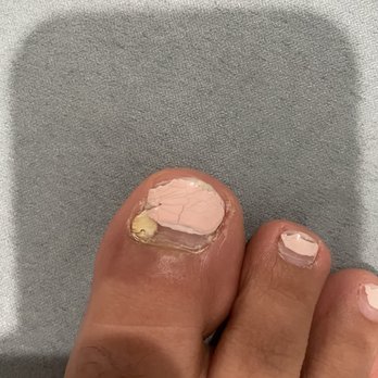 Glamour Nails & Spa - Infected nail - Nail Salons Near Me - Norco, California