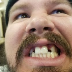 Tuttle Family Dental - Peyton's teeth before!