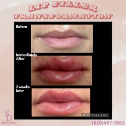 The SD Med Spa - 1 syringe of filler on this new patient gave her the lips of her dreams!