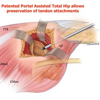 Brad L Penenberg, MD - Patented PATH hip replacement surgery - Orthopedists Near Me - Beverly Hills, California Brad L Penenberg, MD - Patented PATH hip replacement surgery - Orthopedists Near Me - Beverly Hills, California