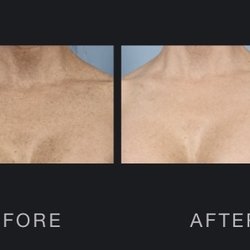 Adirondack Laser & Skin Esthetics - Freckle Removal