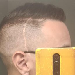 Left side with scar Left side with scar