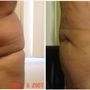 Photo of Los Angeles Liposuction Centers