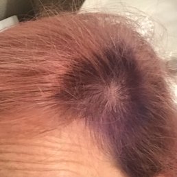 How my stylist dealt with balding spot. Nice! How my stylist dealt with balding spot. Nice!
