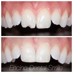 Encino Dental Smile - Composite bonding done to restore chipped tooth as a highly cosmetic treatment option.