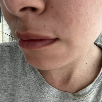 LaserAway - That long line is a scar - Laser Hair Removal Near Me - Chula Vista, California