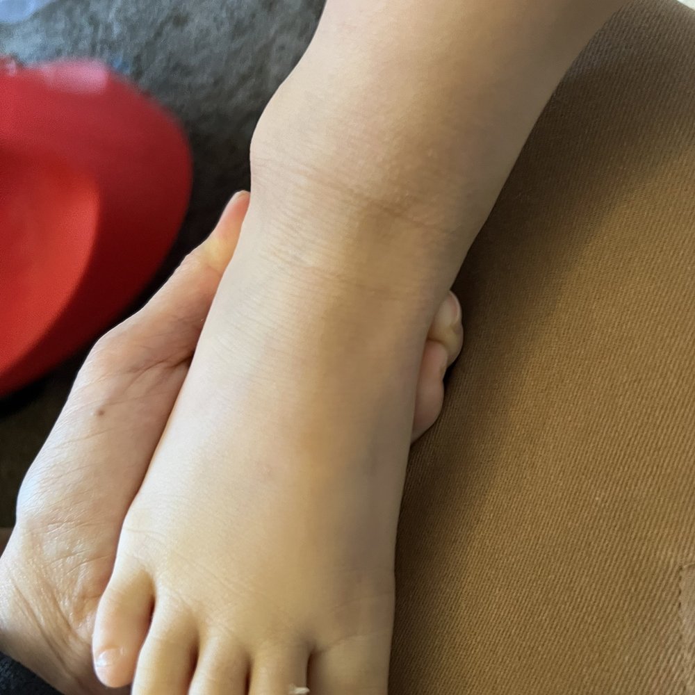 Jofili Pediatrics - Exactly one year after following Dr. Jofili's treatment plan without the use of steroid cream. - Nutritionists Near Me - Los Angeles, California