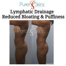 Pure Skinz Aesthetics - Results After Just 4 Sessions * Lymphatic Sculpting Lymphatic Drainage * Lymphatic Well-being