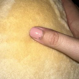 Chipped nail near over flooded cuticles after a week of nail growth. Chipped nail near over flooded cuticles after a week of nail growth.