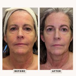 Bloomin' Beauty Esthetics By Cassi - New Bloom Facial w/ RF Skin Tightening + Tightening Protein Booster
AND
Bloomin' Brow Trifecta: Lamination + Wax + Tint