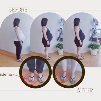 Mara Nicandro, NMT NCBTMB - Before and after on Instagram mara_nmt4health.com preparing for labor. Swollen feet, edema relief - Massage Therapy Near Me - Chicago, Illinois Mara Nicandro, NMT NCBTMB - Before and after on Instagram mara_nmt4health.com preparing for labor. Swollen feet, edema relief - Massage Therapy Near Me - Chicago, Illinois