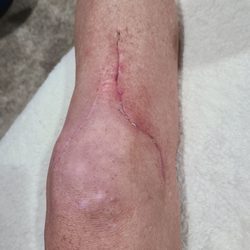 Advantage Rehab & Orthopedic Physical Therapy - About 8 weeks post op -