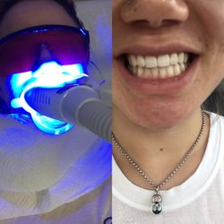 Corpus Waxing Center & Spa - In the process of whitening & after my two 20 minute sessions.