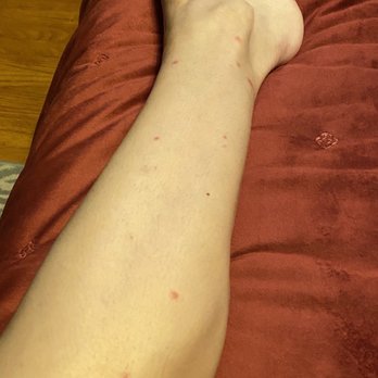 Drury Inn & Suites Sikeston - BEDBUG BITES! - Hotels Near Me - Miner, Missouri