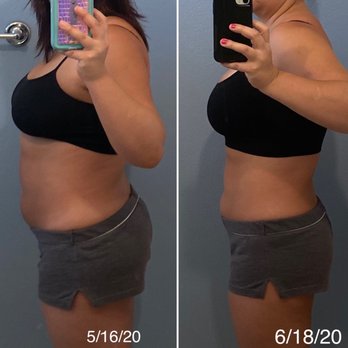 Assif Med Spa - Walking proof this works! Thank you Dr. Assif!! - Medical Spas Near Me - Tustin, California Assif Med Spa - Walking proof this works! Thank you Dr. Assif!! - Medical Spas Near Me - Tustin, California