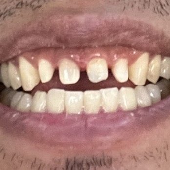 El Segundo Modern Dentistry - Shaving down of damaged teeth in mold fitting for crowns - General Dentistry Near Me - El Segundo, California El Segundo Modern Dentistry - Shaving down of damaged teeth in mold fitting for crowns - General Dentistry Near Me - El Segundo, California