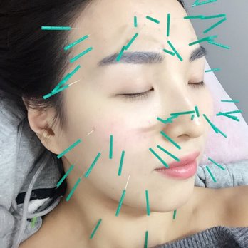 Johnny Leung Acupuncture - Facial Rejuvenation Acupuncture - Acupuncture Near Me - New York, New York Johnny Leung Acupuncture - Facial Rejuvenation Acupuncture - Acupuncture Near Me - New York, New York