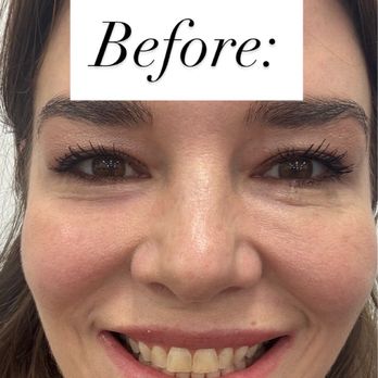 Brighter Smiles of Davidson - Before - Teeth Whitening Near Me - Cornelius, North Carolina Brighter Smiles of Davidson - Before - Teeth Whitening Near Me - Cornelius, North Carolina