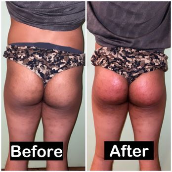 The Glow Up - Body Contouring Near Me - Honolulu, Hawaii