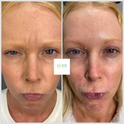 Derm Perfect The Elites' Medspa - 2 weeks after Injections of forehead and 11 lines