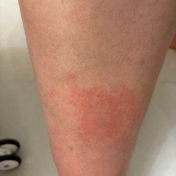 My Dear Nail - Here is my burn from the evening of the same day . - Nail Salons Near Me - Tempe, Arizona My Dear Nail - Here is my burn from the evening of the same day . - Nail Salons Near Me - Tempe, Arizona