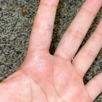 Pro Nails & Spa - Smfh look how red my hand is - Nail Salons Near Me - Laurel, Maryland