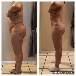 2 weeks vs 11 1/2 weeks post opp