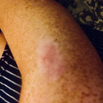 Glo Sun Spa - my hydration station scar burn a month later. Not even an apology. In fact Britt chewed me out. GO ELSEWHERE! - Spray Tanning Near Me - Houston, Texas Glo Sun Spa - my hydration station scar burn a month later. Not even an apology. In fact Britt chewed me out. GO ELSEWHERE! - Spray Tanning Near Me - Houston, Texas