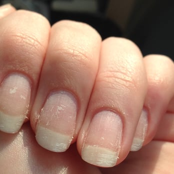 Pinky & Toes Nail Studio - Scratched up, peeling, weakened, ruined natural nails from a simple gel polish removal. This is AFTER I asked him to fix his work. - Waxing Near Me - Shrewsbury, Massachusetts