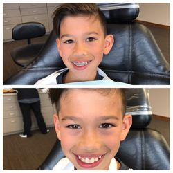 Davies Orthodontics - Braces on braces off