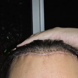 Rumer Cosmetic Surgery - This is what the doctor fixed and shows what a proper hairline lowering procedure looks like