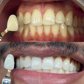 The Coco Blanc Teeth Whitening - Teeth Whitening Near Me - Whittier, California The Coco Blanc Teeth Whitening - Teeth Whitening Near Me - Whittier, California