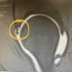 Michael J Huang, MD - CSOG MRI 4/1/22, shows tear in labrum