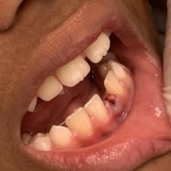 Darrin Hirt, DDS - After the pull. - Pediatric Dentists Near Me - Beverly Hills, California Darrin Hirt, DDS - After the pull. - Pediatric Dentists Near Me - Beverly Hills, California