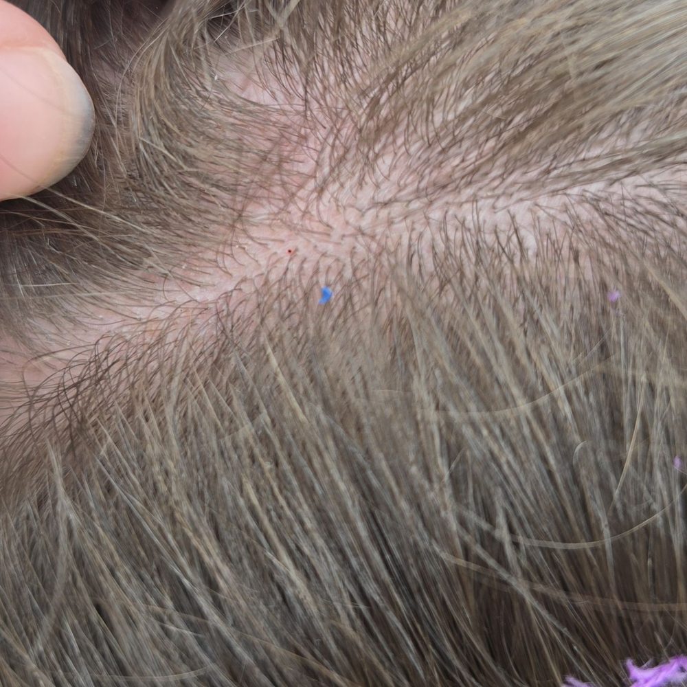 Beach Hut - Zoomed in on scalp that has bruising and follicle bleeding. Couldn't get a good shot but tried in cloudy environment - Hobby Shops Near Me - Panama City Beach, Florida Beach Hut - Zoomed in on scalp that has bruising and follicle bleeding. Couldn't get a good shot but tried in cloudy environment - Hobby Shops Near Me - Panama City Beach, Florida