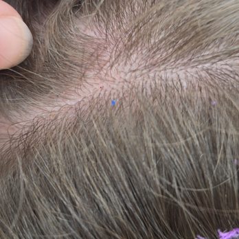 Beach Hut - Zoomed in on scalp that has bruising and follicle bleeding. Couldn't get a good shot but tried in cloudy environment - Hobby Shops Near Me - Panama City Beach, Florida Beach Hut - Zoomed in on scalp that has bruising and follicle bleeding. Couldn't get a good shot but tried in cloudy environment - Hobby Shops Near Me - Panama City Beach, Florida