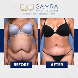 Asaad H. Samra, MD, FACS - Bikini season is right around the corner ... are you ready?!  Get ready to hit the sand in style with your dream body